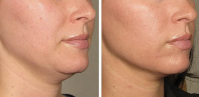 Anti Aging/Skin Tightening